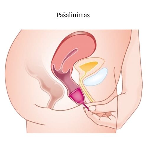 Menstruacines taureles pasalinimas